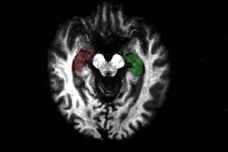black and white images of brain
